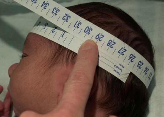 Microcephaly-picture-of-head-circumferenec-measurement (1).jpg