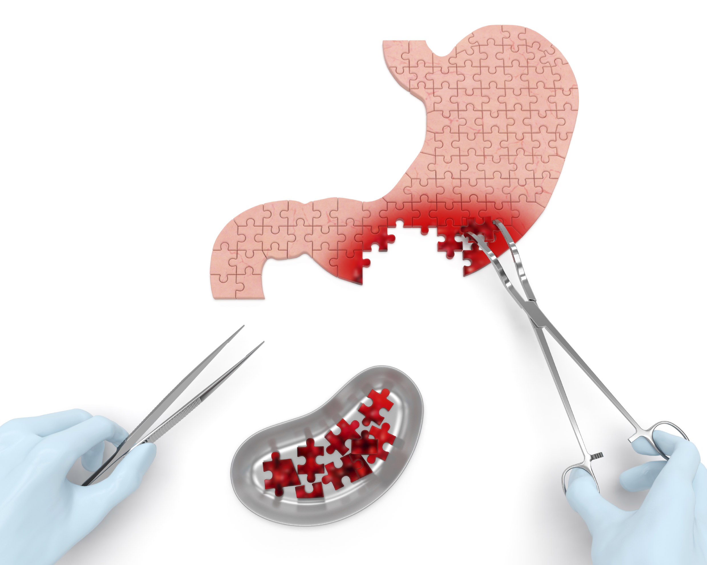 Химиотерапии после удаления желудка. Химиотерапии после удаления желудка. Лучевая терапия при онкологии прямой кишки. Химиопрепараты при онкологии желудка. Лучевая терапия при онкологии прямой кишки.