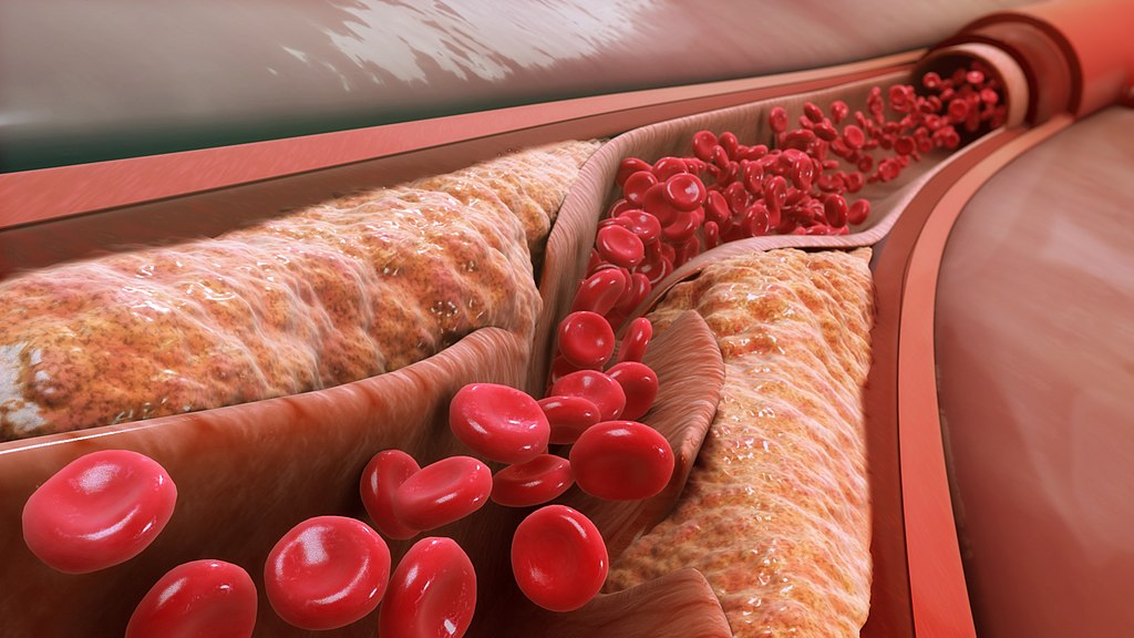 LDL causes the progression of atherosclerosis and blocks the artery lumen.jpg