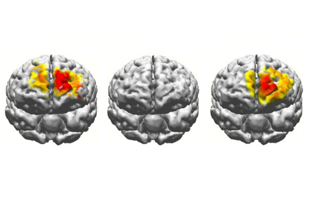 electrostimulation-brain-comparison.jpg
