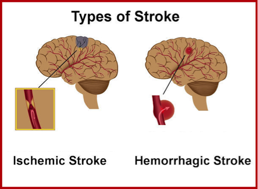 image-of-types-of-stroke.png