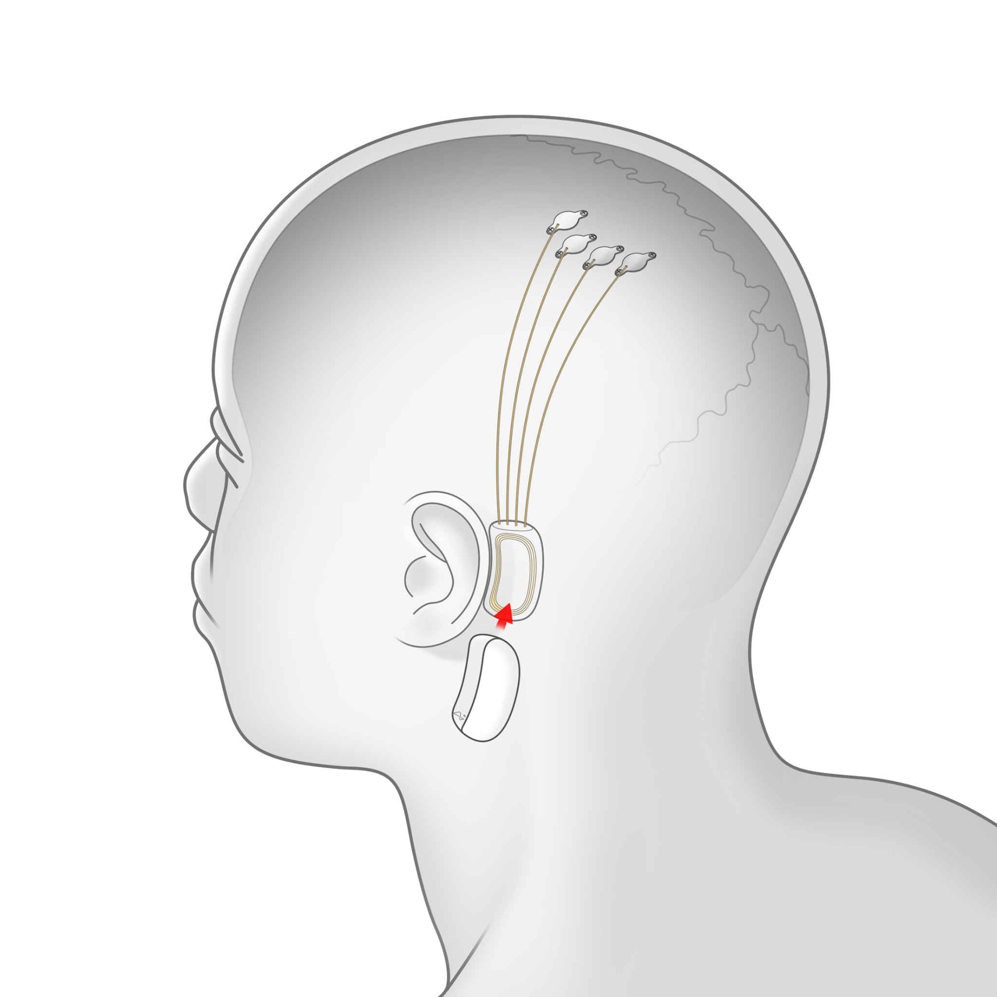 Neuralink_electrode_implant.jpg