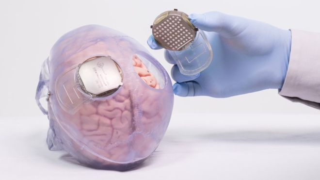 brain-implants.jpg